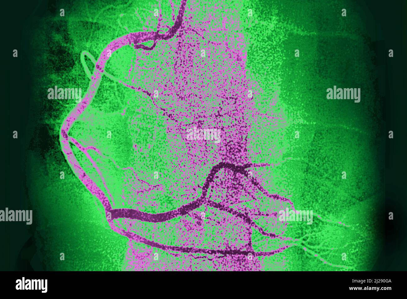 Artère coronaire droite Banque D'Images