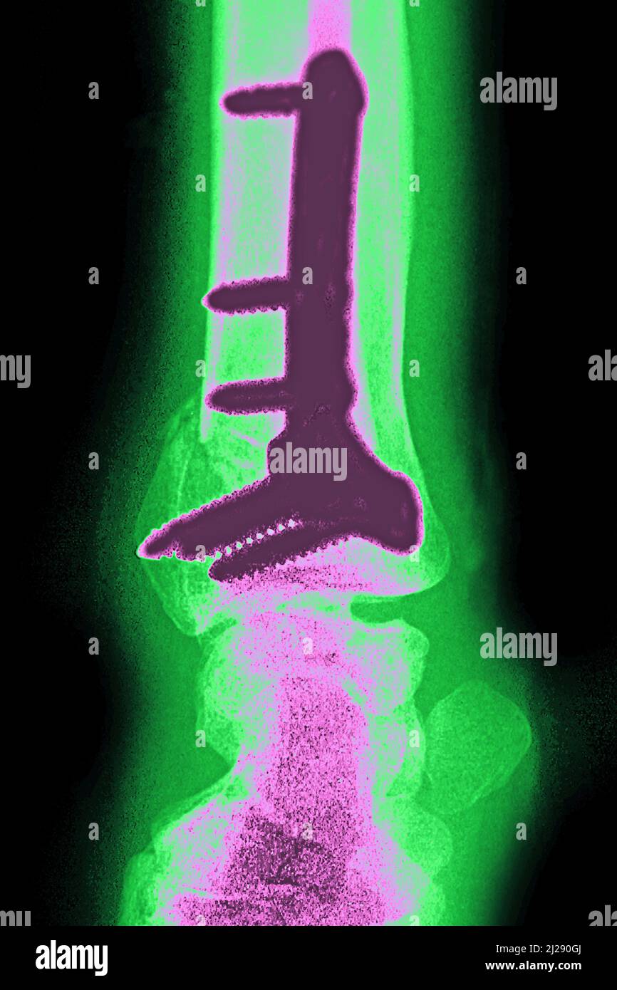 Ostéosynthèse du poignet Banque D'Images