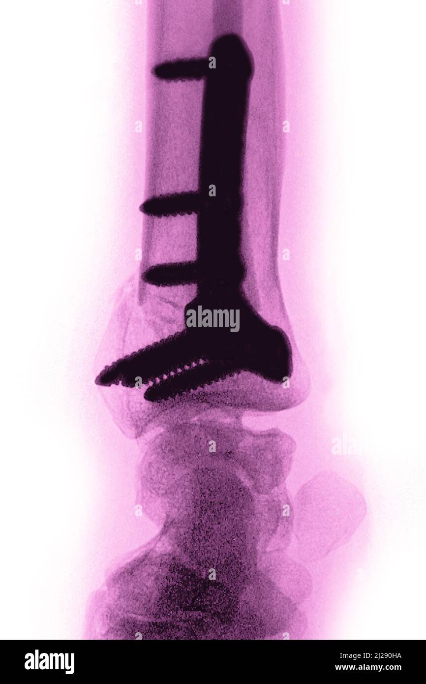 Ostéosynthèse du poignet Banque D'Images