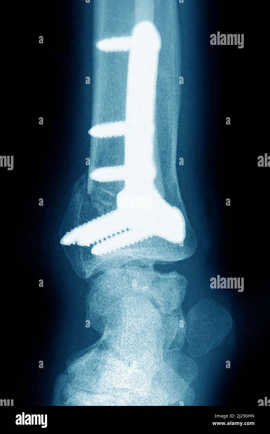 Ostéosynthèse du poignet Banque D'Images