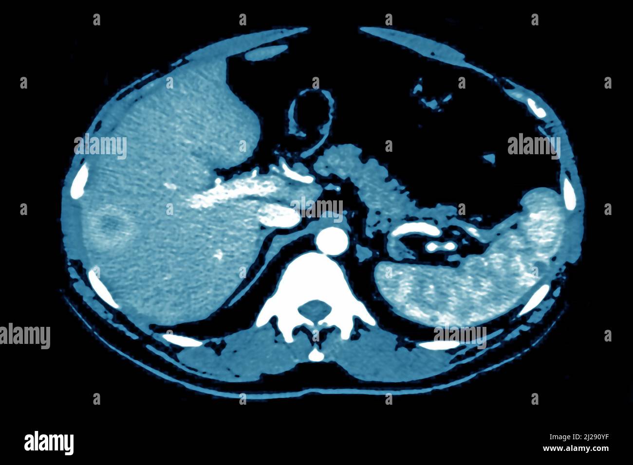 Lymphoreticulosis Banque D'Images