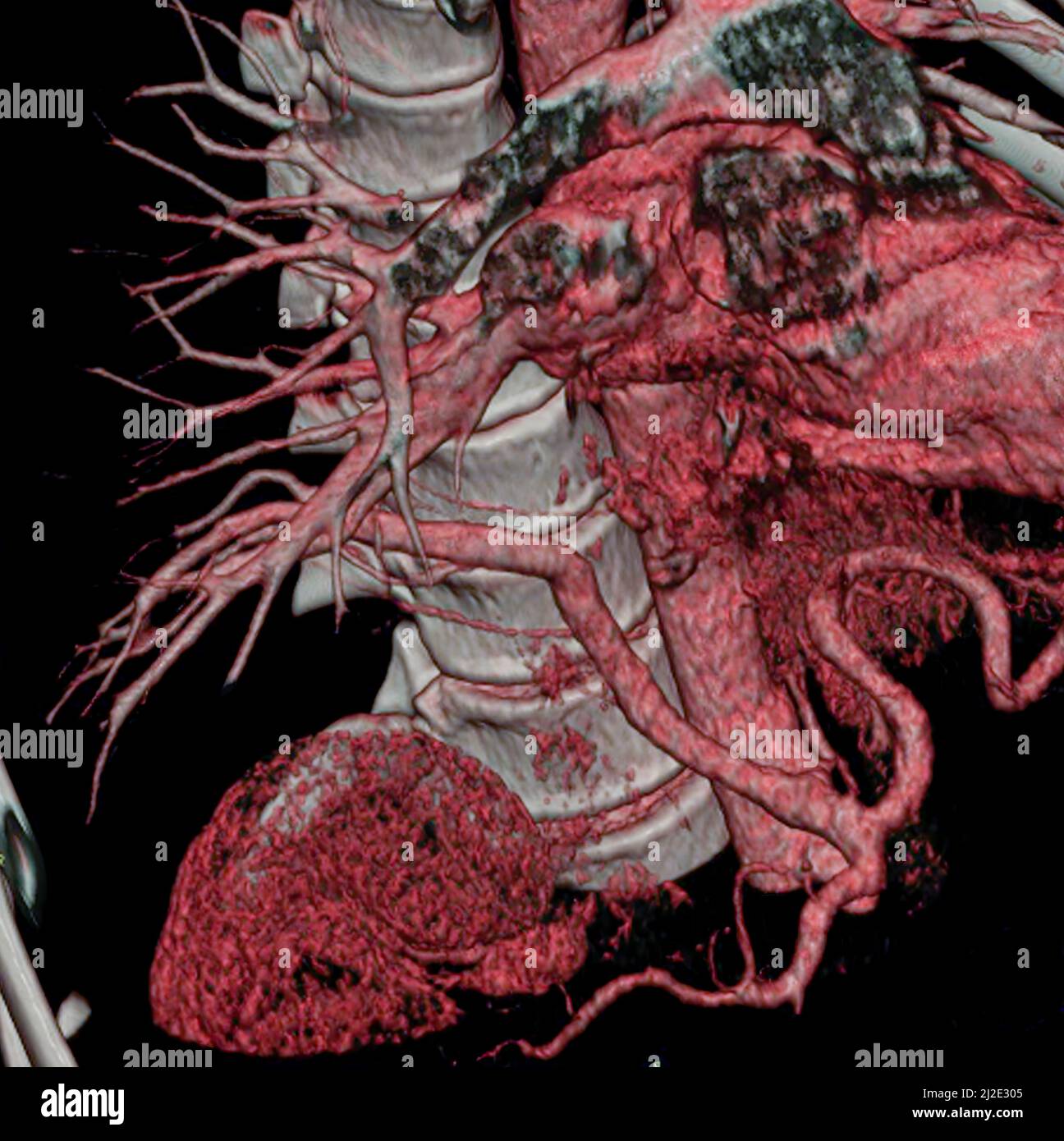 Anomalie congénitale, poumon Banque D'Images