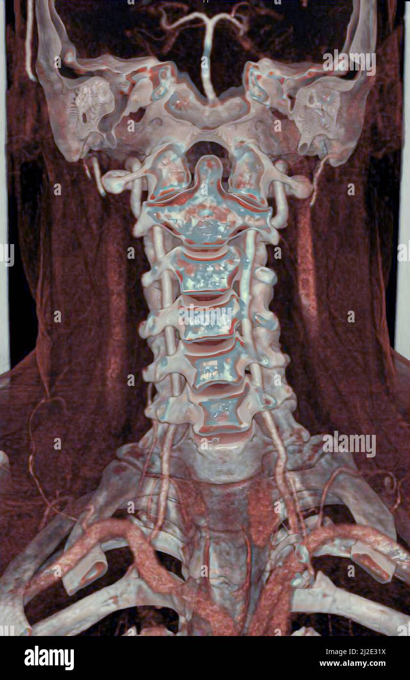 Vertèbre cervicale, acquisition Banque D'Images
