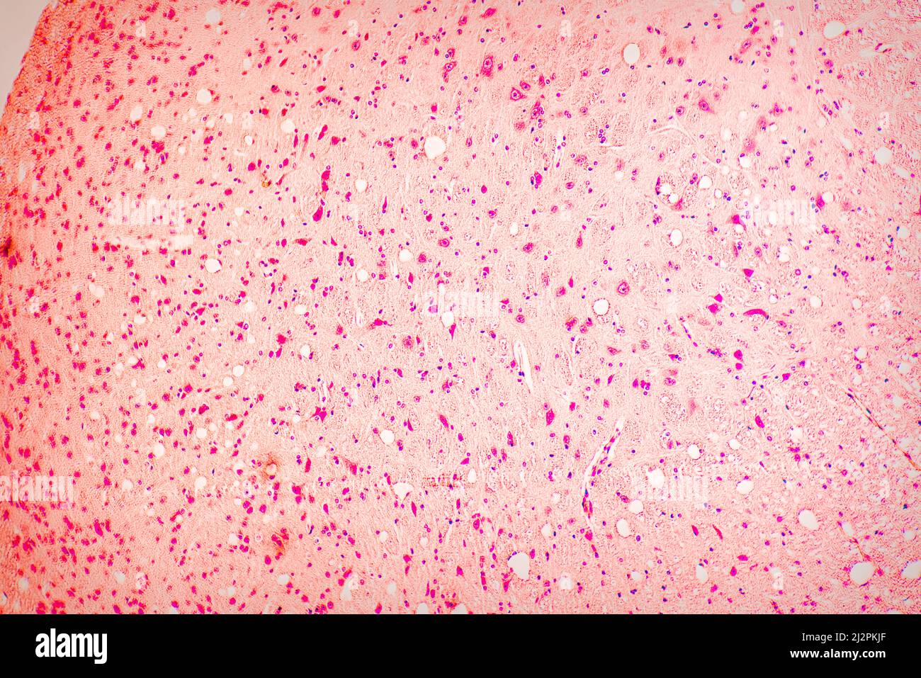 biopsie des coupes de tissus pour vérifier la présence d'une tumeur maligne. Vue au microscope Banque D'Images