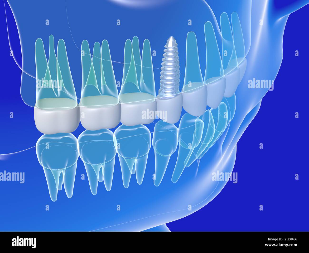 3d illustration d'un implant dentaire. Image anatomique des dents et de la bouche, transparente sur fond bleu. Banque D'Images