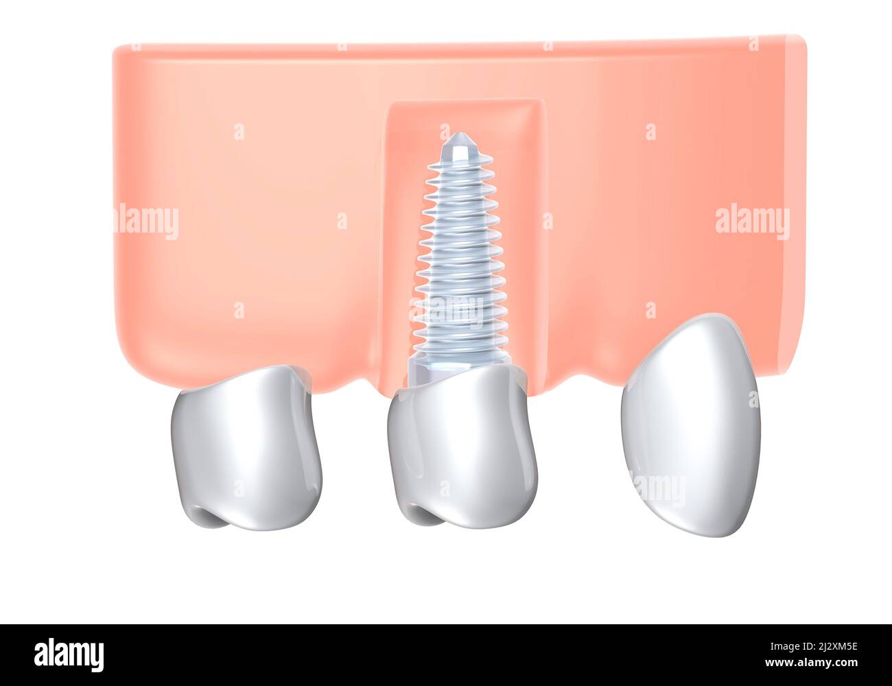3d illustration d'un implant dentaire dans une gencive. Style graphique Ixométrique. Image anatomique de la prothèse sur fond blanc. Banque D'Images