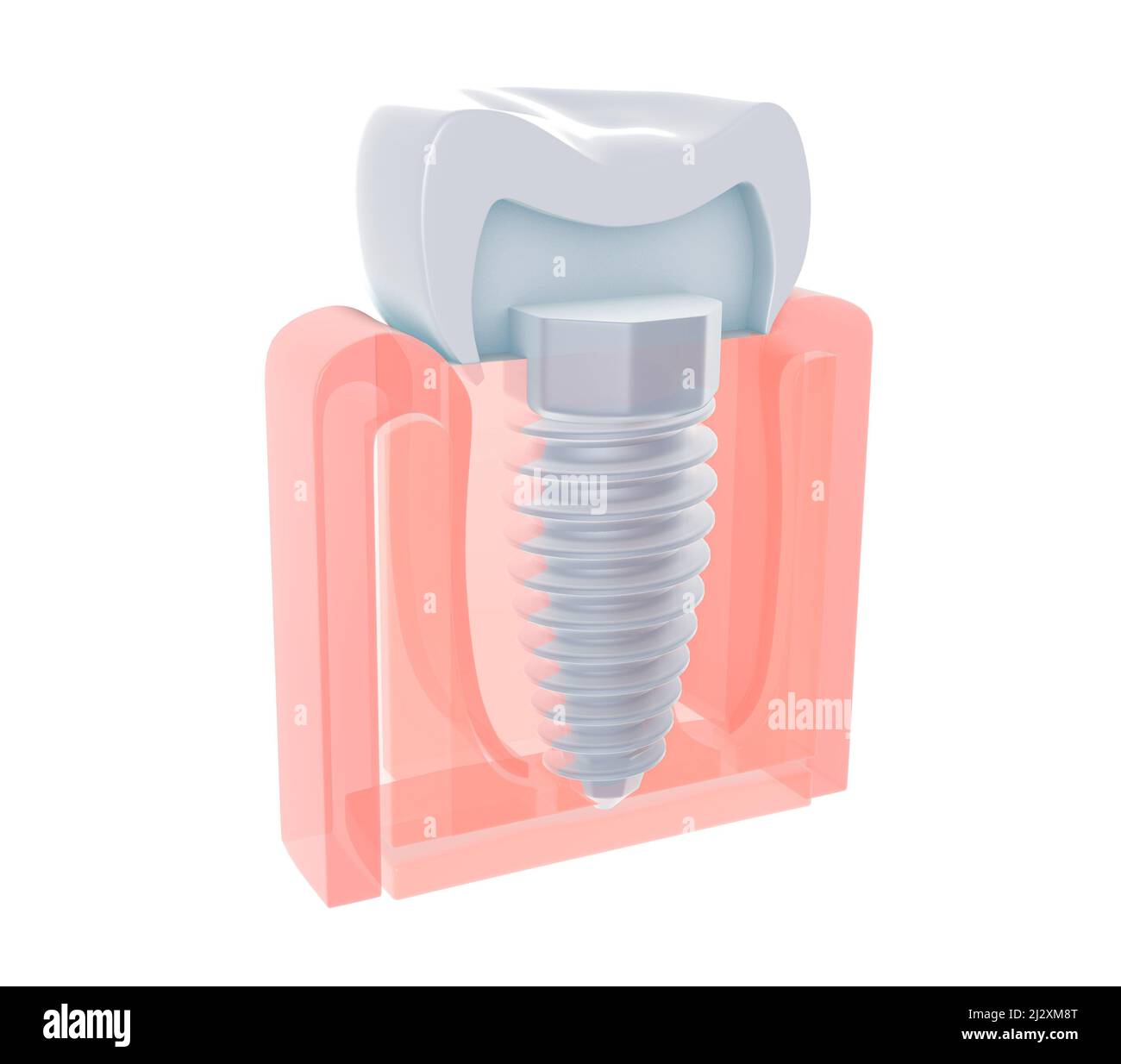 3d illustration de la vue anatomique d'une dent ou d'un implant dentaire. Vissé dans l'os. Style transparent sur fond blanc. Banque D'Images