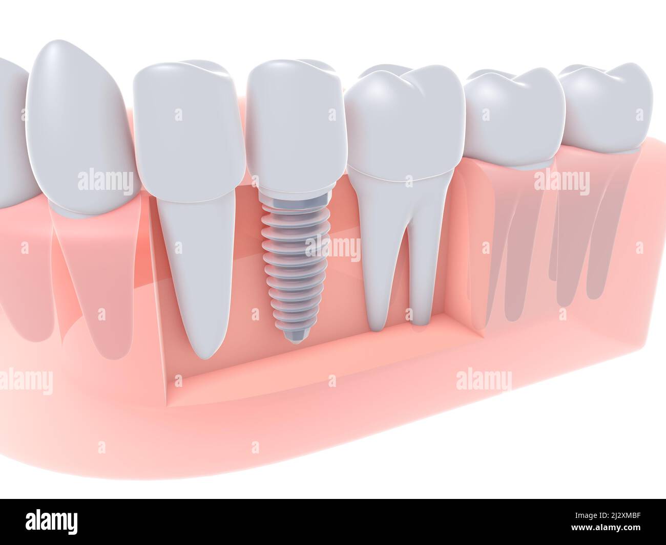 3d illustration d'un implant dentaire inséré dans une gencive, avec les dents et les molaires. Vue anatomique de la prothèse sur fond blanc. Banque D'Images