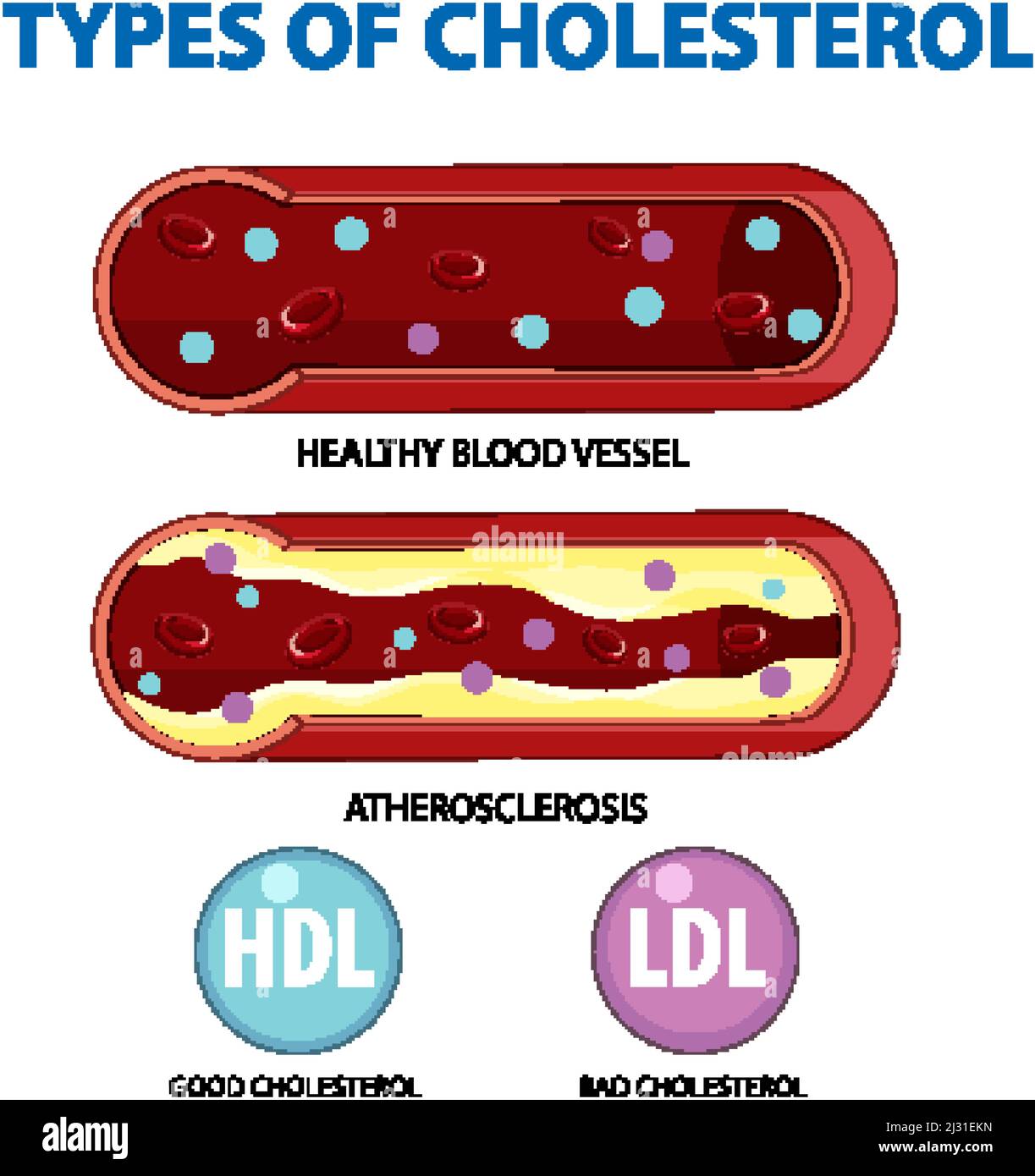 Types de cholestérol HDL et LDL illustration Image Vectorielle ...