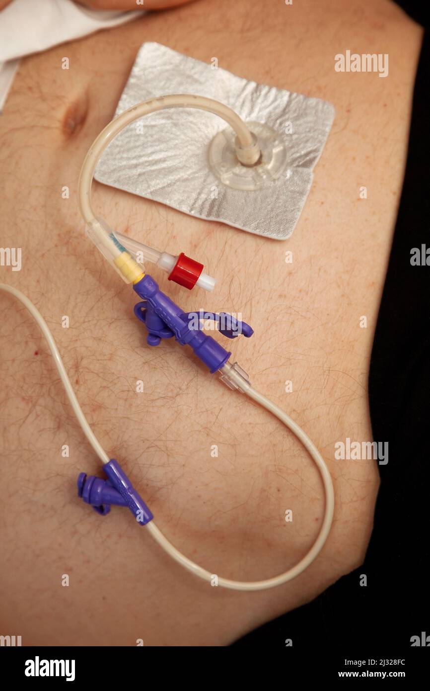 Gastrostomie endoscopique percutanée Banque de photographies et d