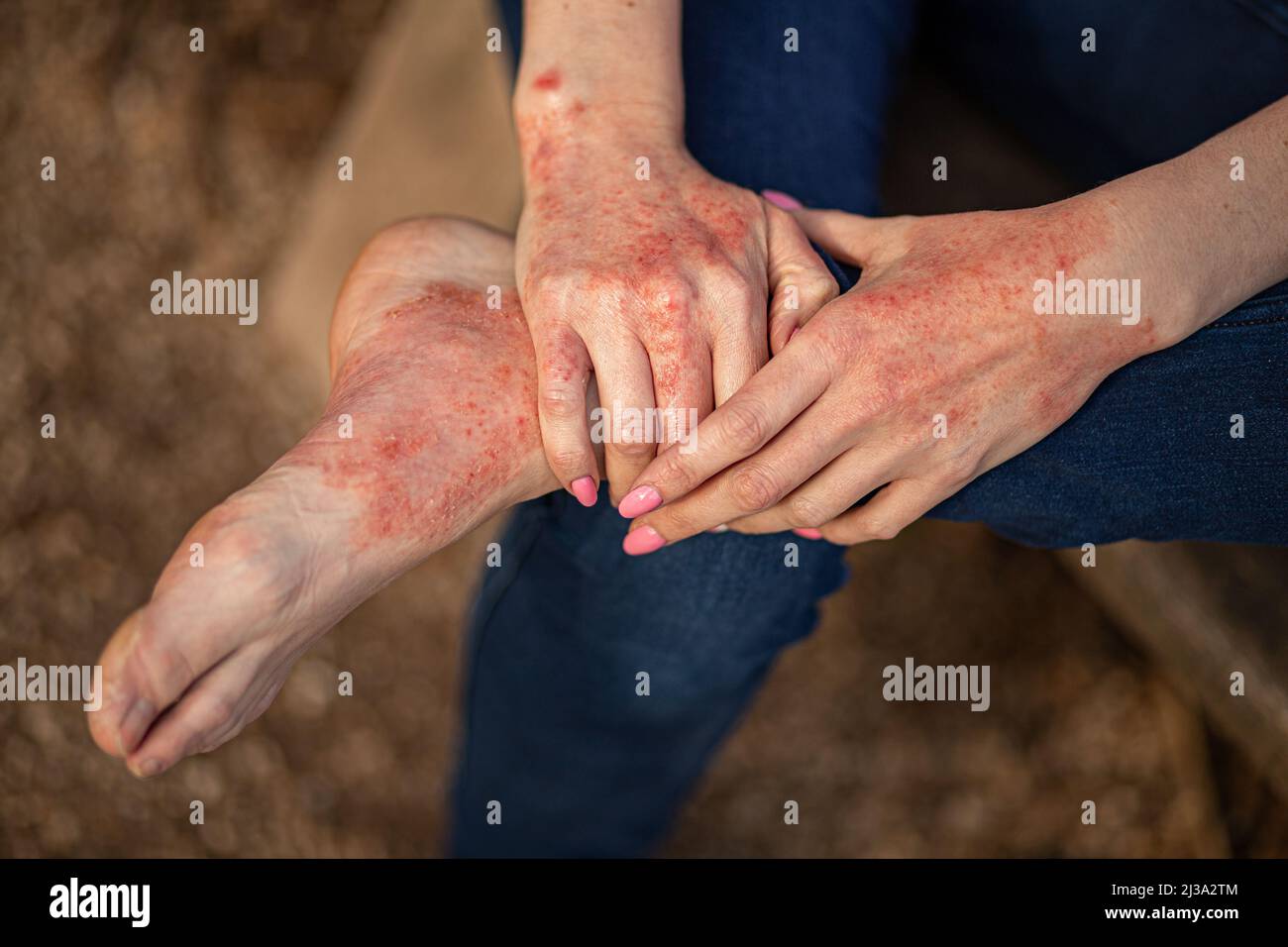 dermatite d'eczéma sur les mains et les pieds. taches rouges sur la peau. peau sèche. Banque D'Images