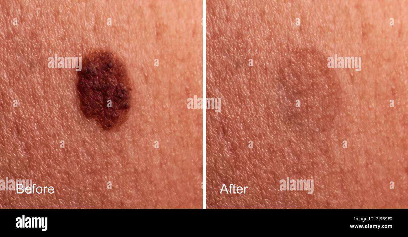 Photo avant et après l'enlèvement de la grosse mole sur la peau de la femme. Concept de suppression de mole Banque D'Images