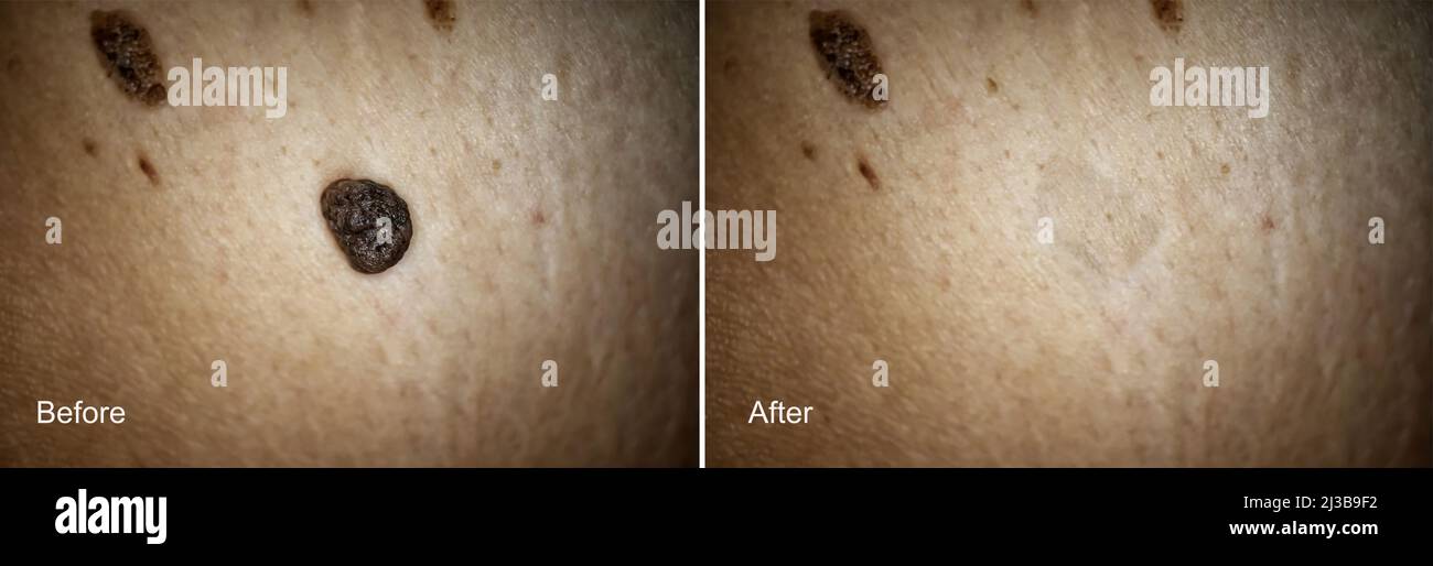 Photo avant et après l'enlèvement de la grosse Mole sur la peau de la femme. Concept de suppression de mole. Mise au point sélective Banque D'Images