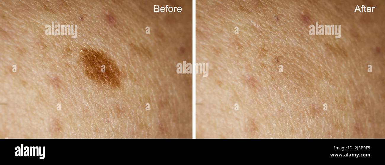 Photo avant et après l'enlèvement de la grosse mole sur la peau de la femme. Mise au point sélective. Concept de suppression de mole Banque D'Images