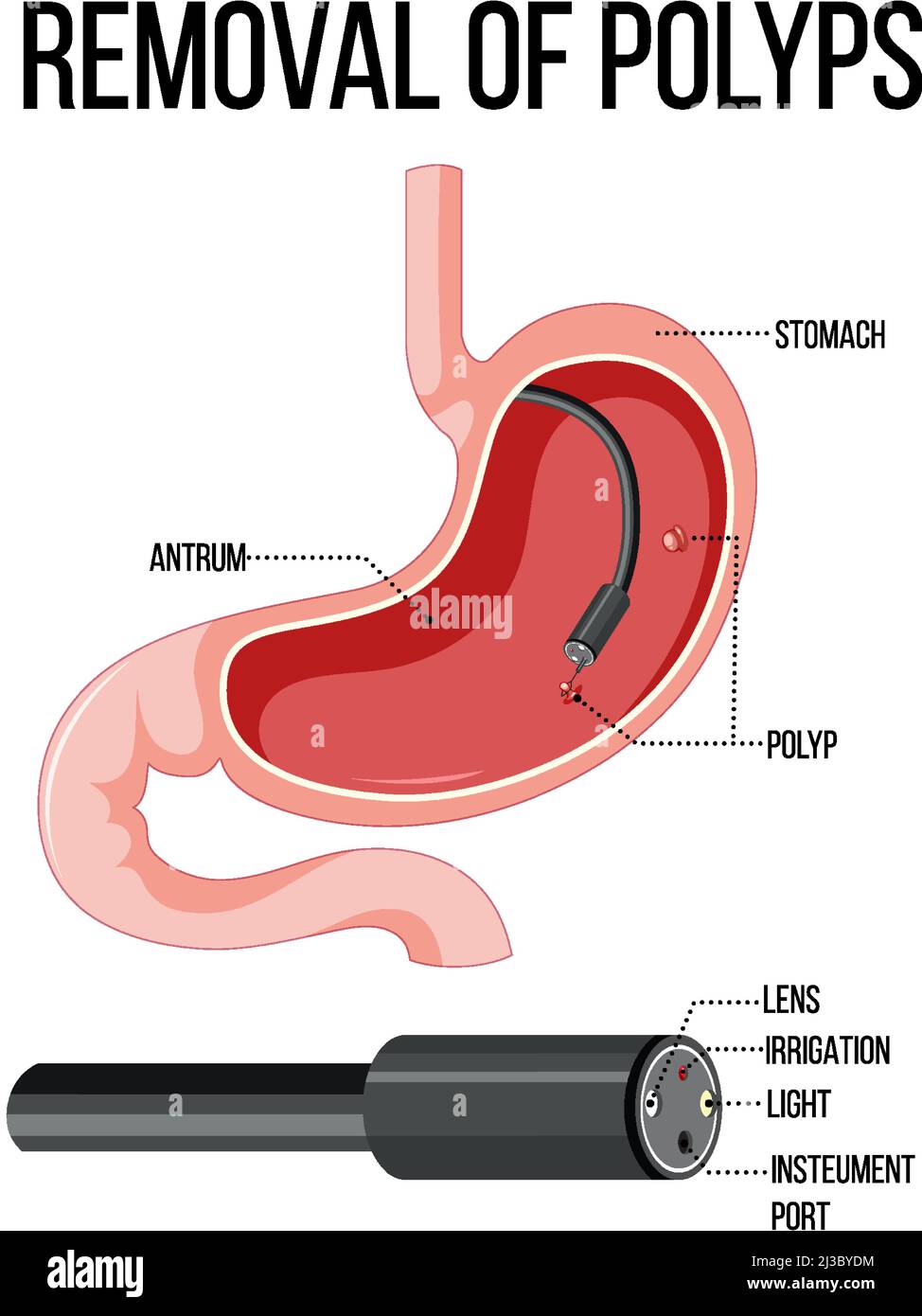 Schéma illustrant la suppression des polypes Illustration de Vecteur