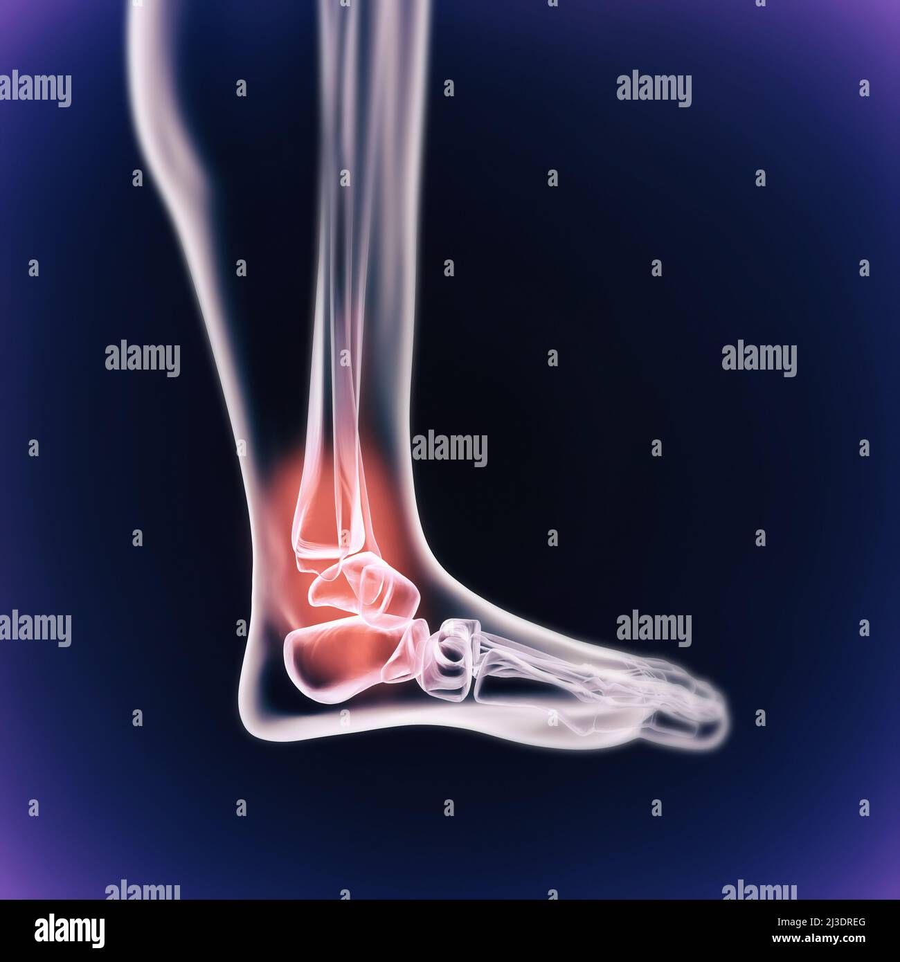 Quand l'inflammation frappe.Vue cgi d'un joint enflammé isolé en bleu. Banque D'Images