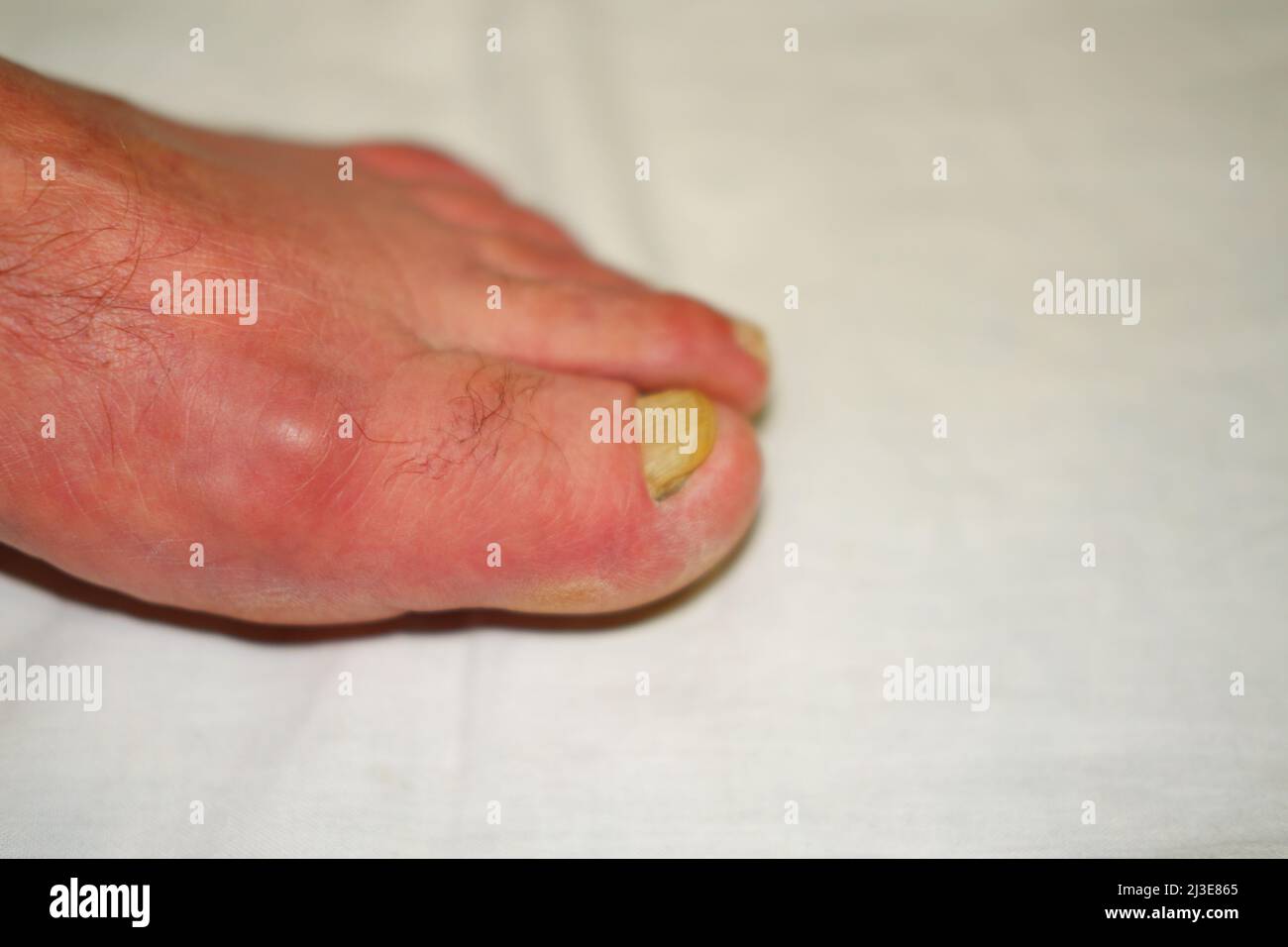 Toenails avec infection fongique des ongles Banque D'Images