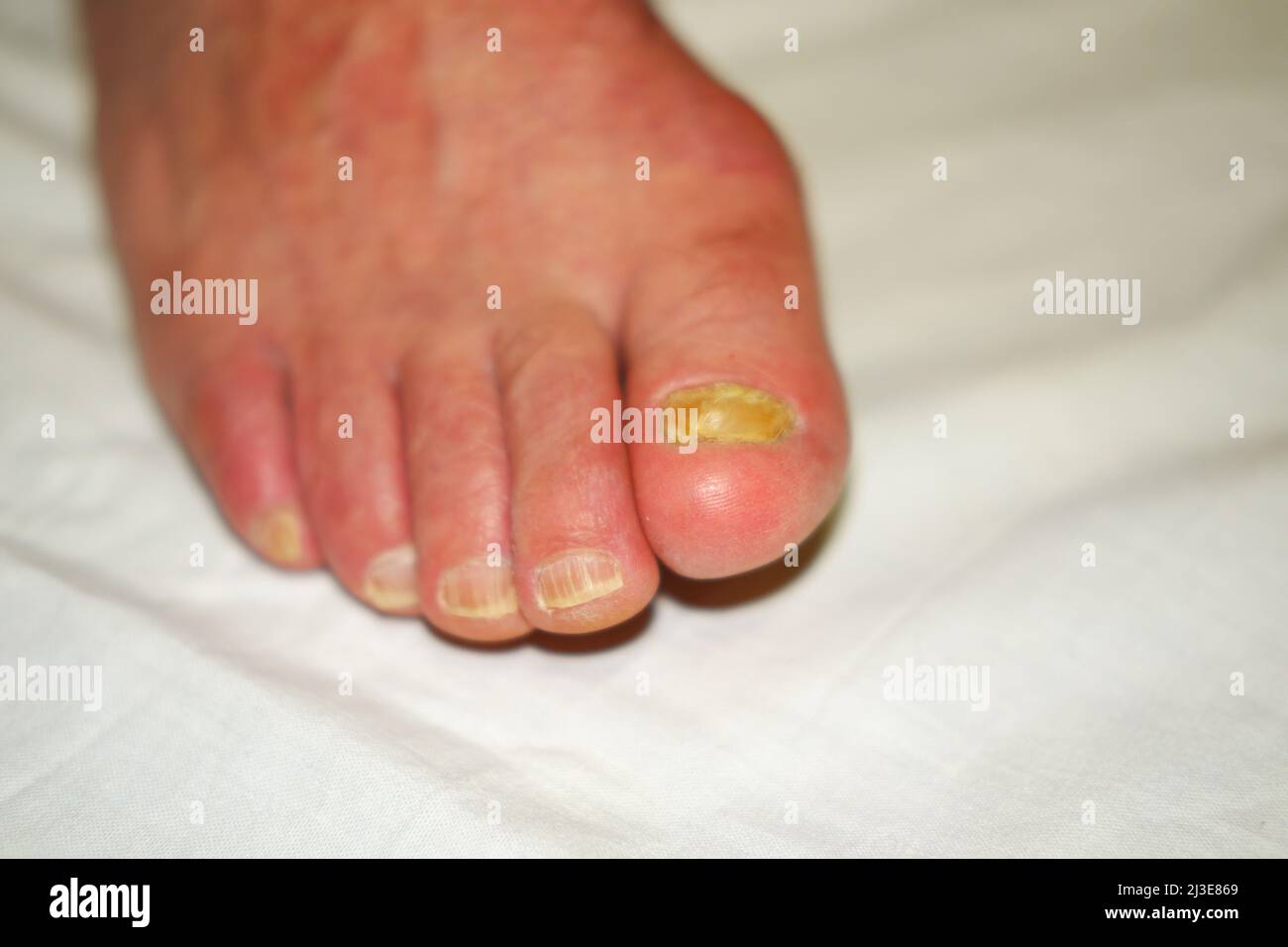 Toenails avec infection fongique des ongles Banque D'Images