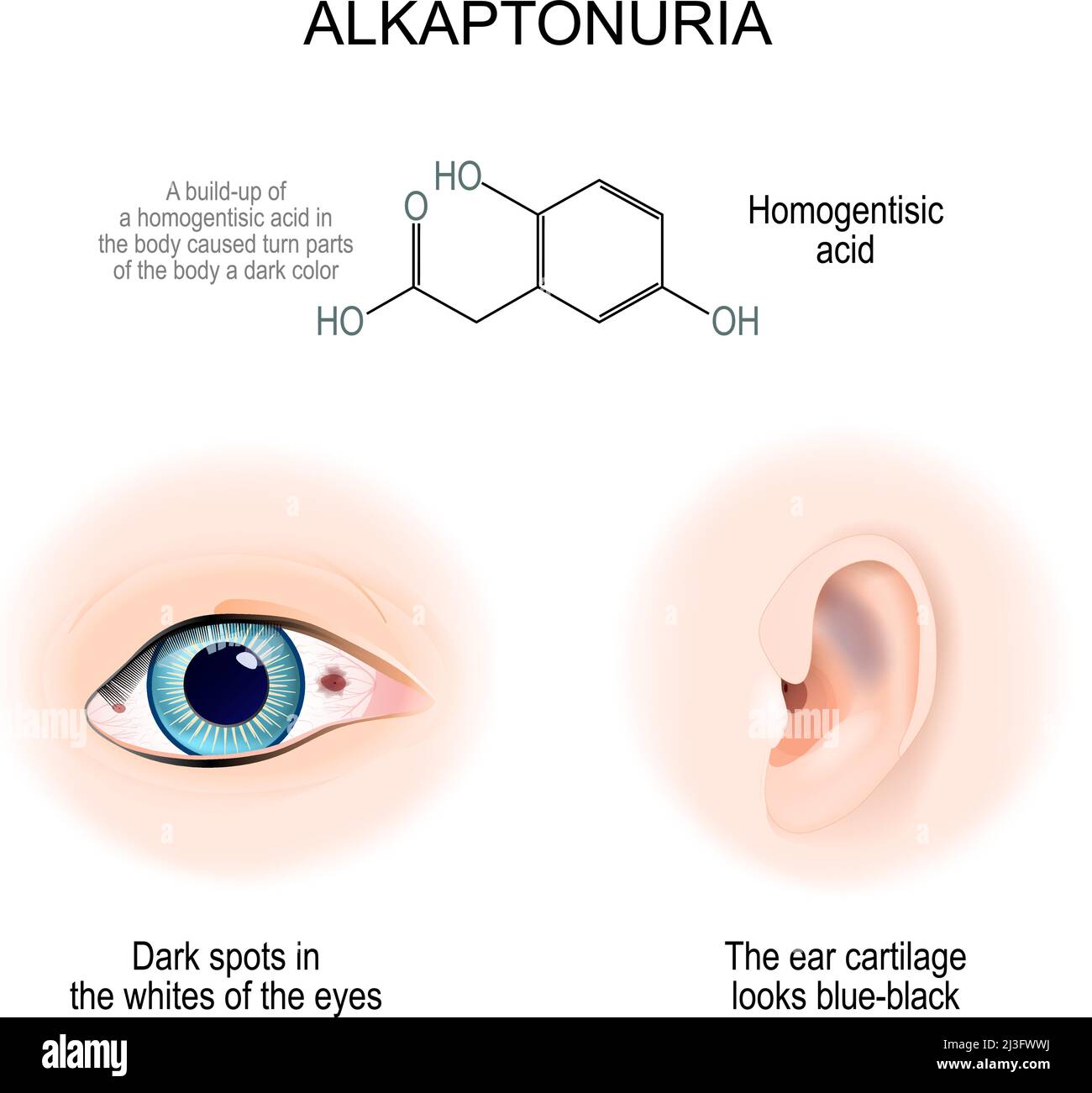 Alkaptonurie. Une accumulation d'acide homogentisique dans le corps a provoqué une couleur foncée dans les parties du corps. Taches sombres dans les blancs de l'œil. L'oreille c Illustration de Vecteur