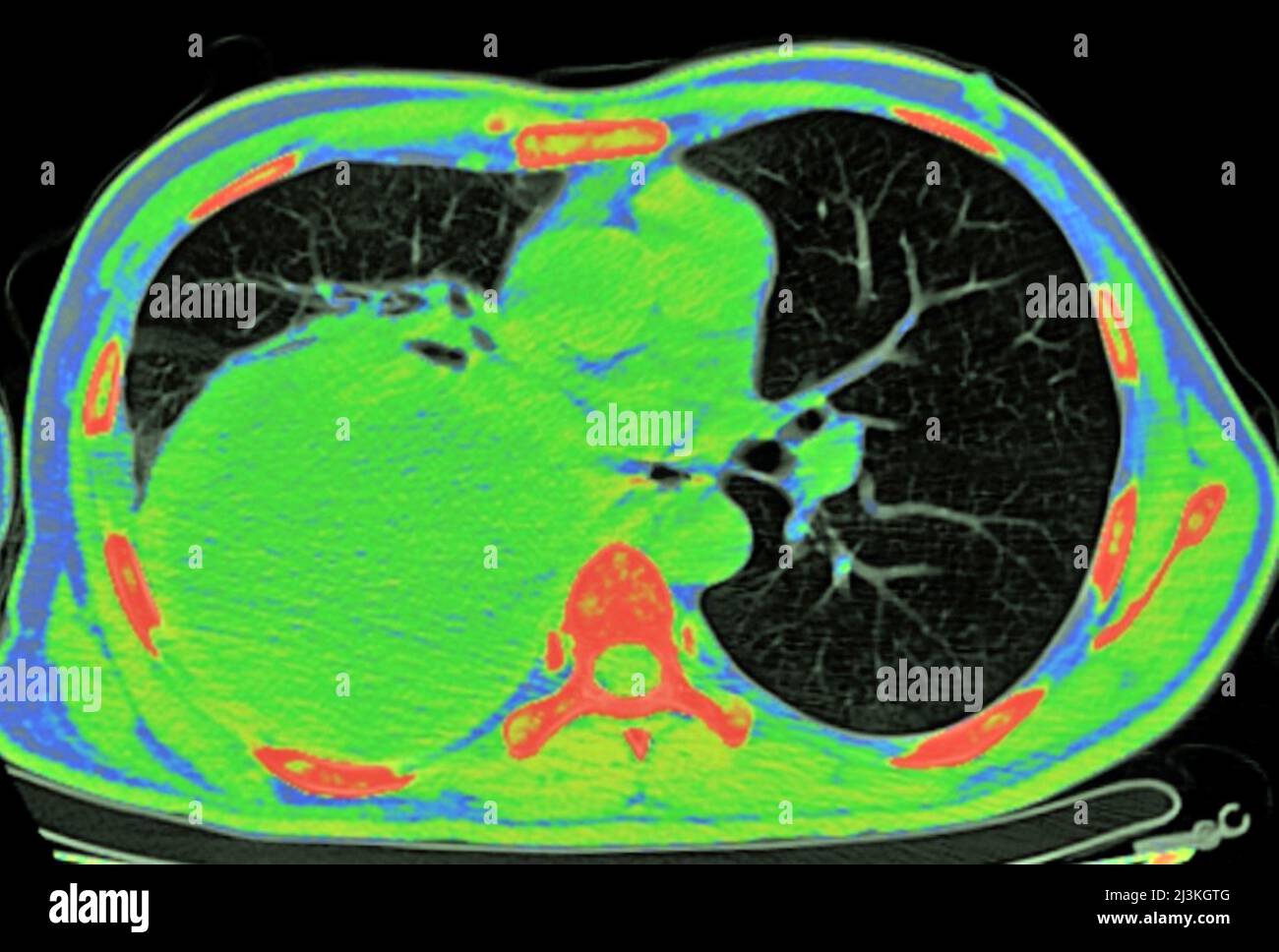 Empyème pleural, acquisition CT Banque D'Images