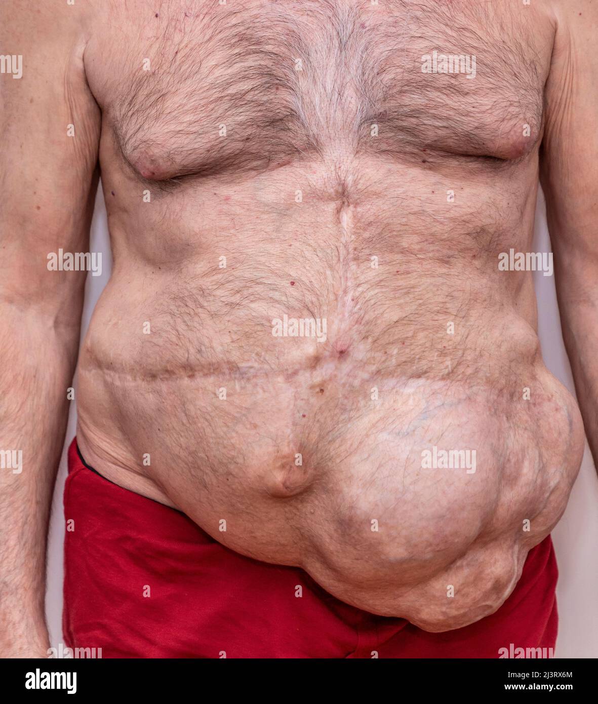 Vue avant de l'incisional abdominal multiplier les hernies. Banque D'Images Vue avant de l'incisional abdominal multiplier les hernies. Banque D'Images