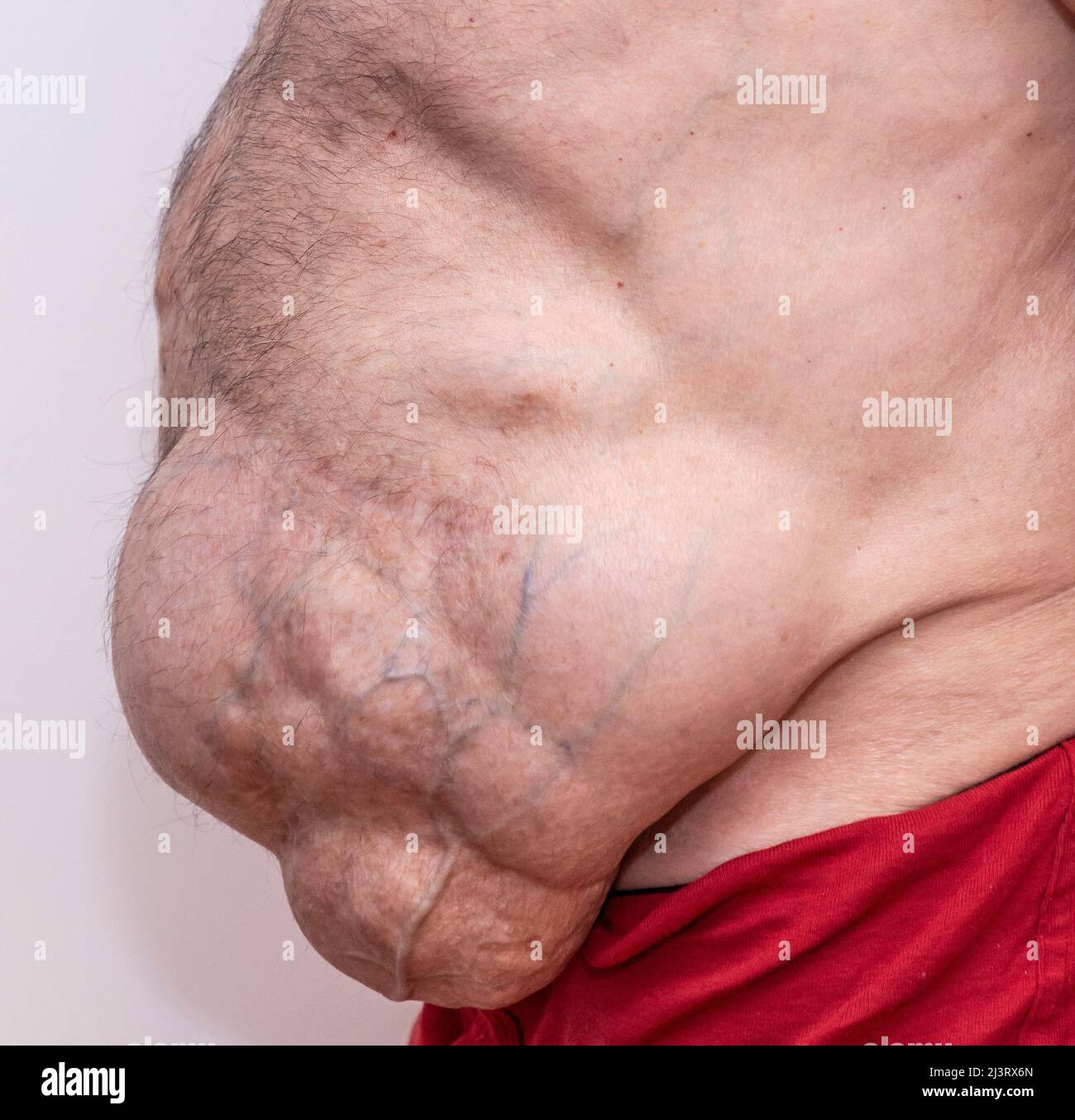 Vue rapprochée de la hernie incisionnelle abdominale. Vue latérale. Banque D'Images Vue rapprochée de la hernie incisionnelle abdominale. Vue latérale. Banque D'Images