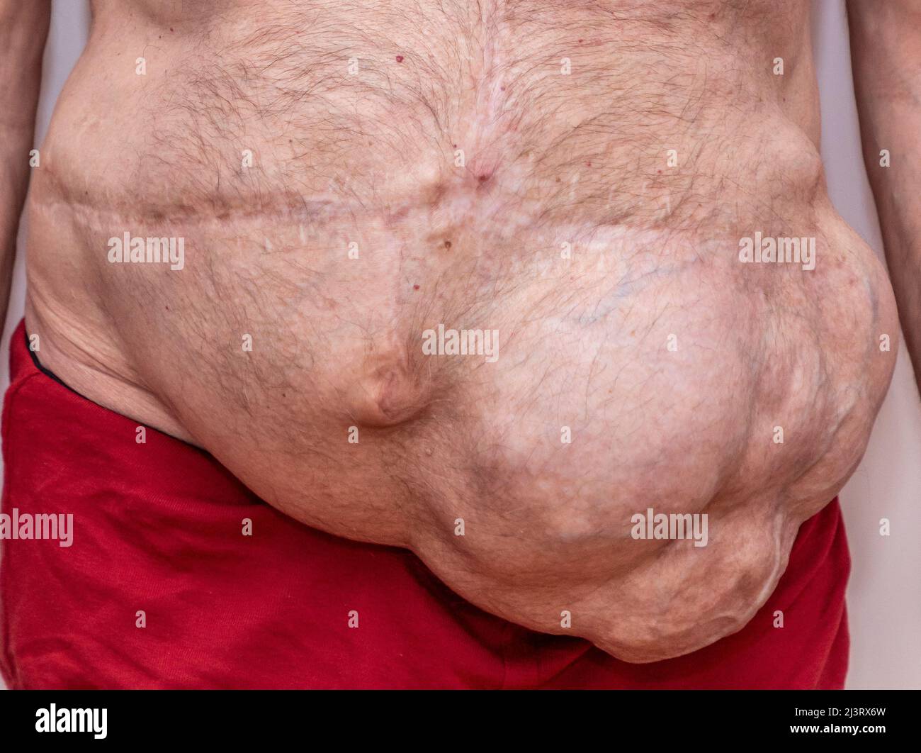 Vue rapprochée de la hernie incisionnelle abdominale Banque D'Images Vue rapprochée de la hernie incisionnelle abdominale Banque D'Images