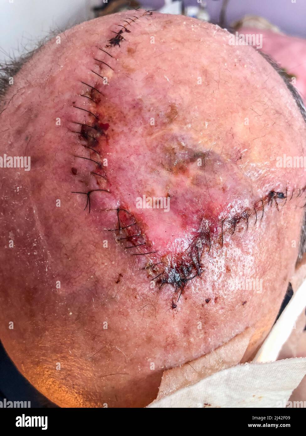 Cicatrices après carcinome épidermoïde de la chirurgie du cuir chevelu Banque D'Images