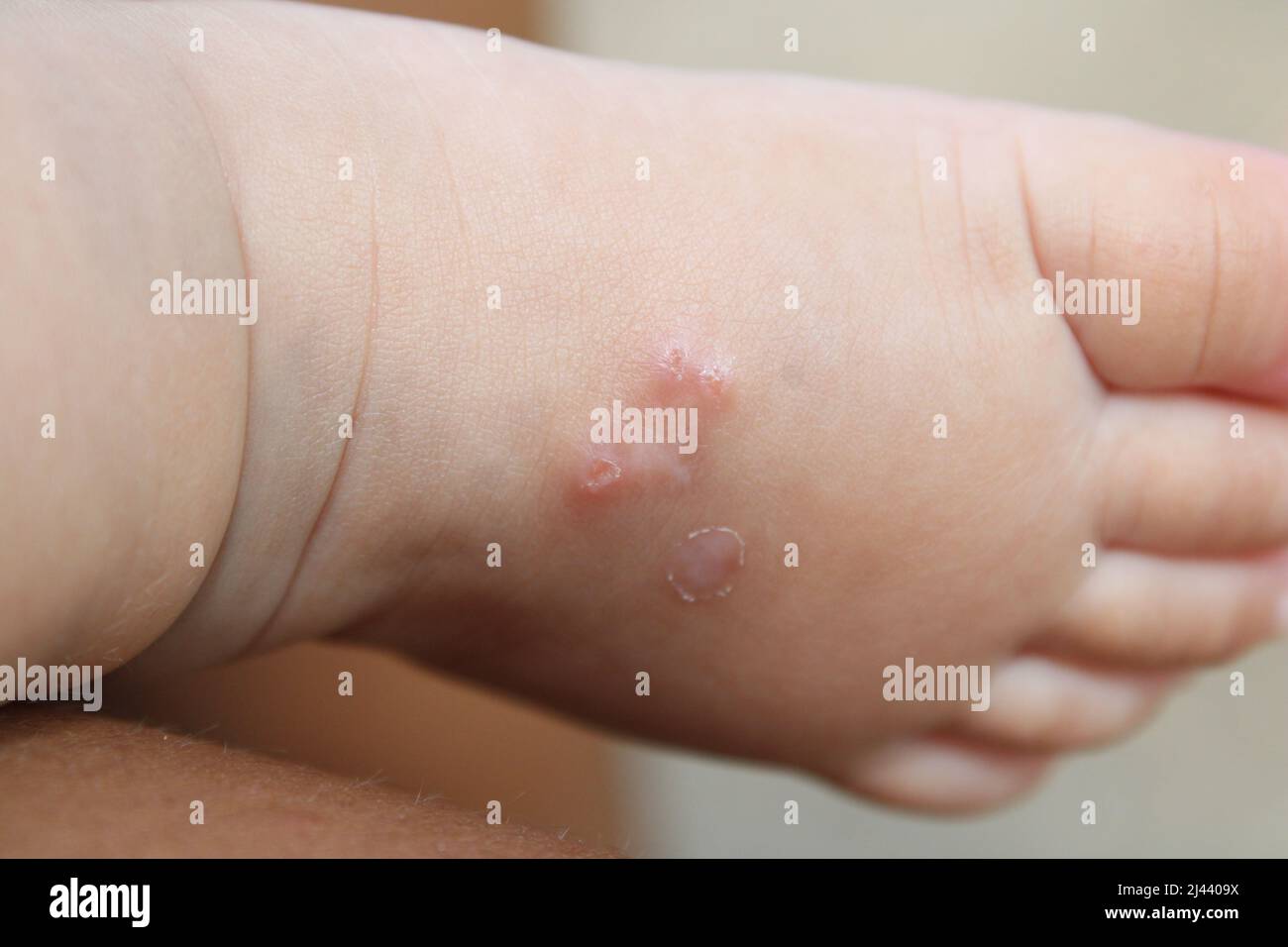 Gros plan du pied d'un bébé atteint de gale (gale sarcoptique), capturé à Port Moresby, Papouasie-Nouvelle-Guinée, 2022. Idéal pour la médecine, la dermatologie, Banque D'Images