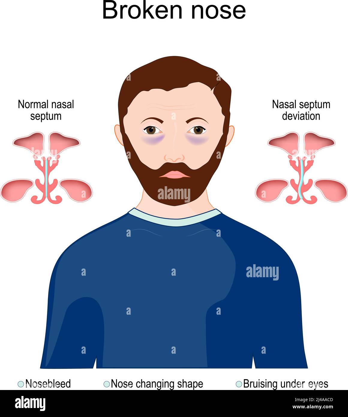 Symptômes d'un nez brisé : nez changeant de forme, ecchymoses sous les yeux. Comparaison de la déviation normale du septum nasal et du septum nasal. Diagramme vectoriel Illustration de Vecteur