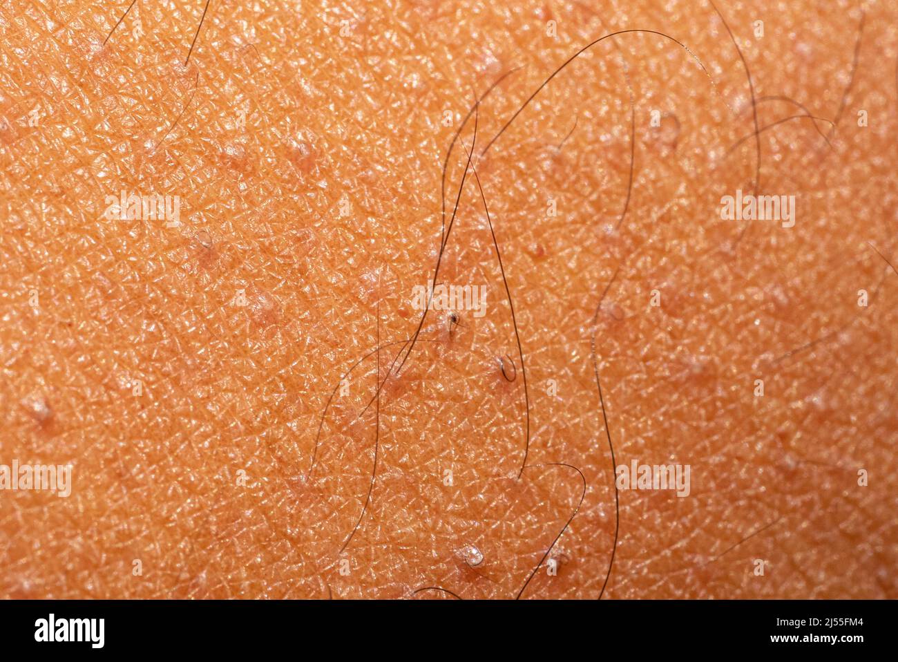Photo macro de peau brune avec kératose pilaris et poils incarnés. Les détails et la texture de la peau sont clairement visibles. Banque D'Images