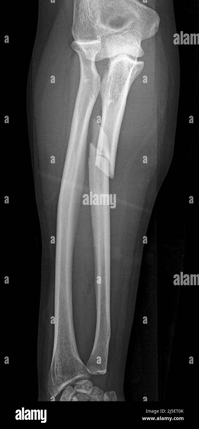 Fracture de la tête radiale Banque de photographies et d’images à haute ...