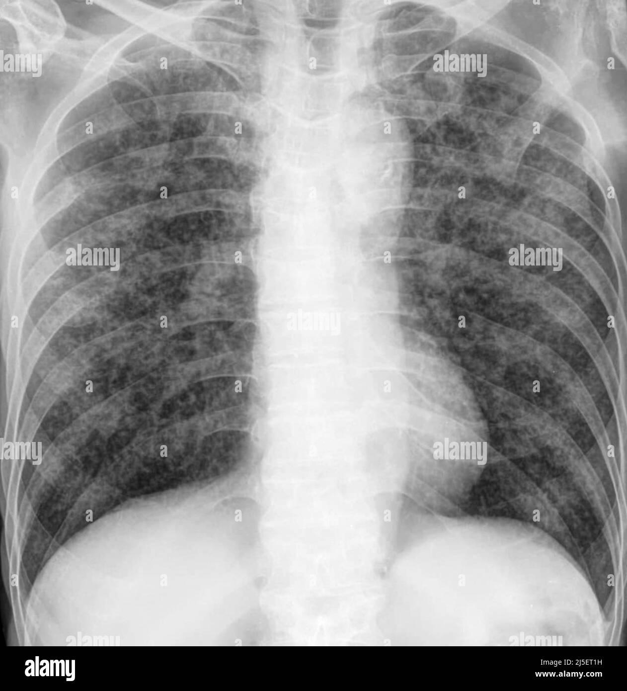 Nodules pulmonaires Banque de photographies et d'images à haute résolution  - Alamy