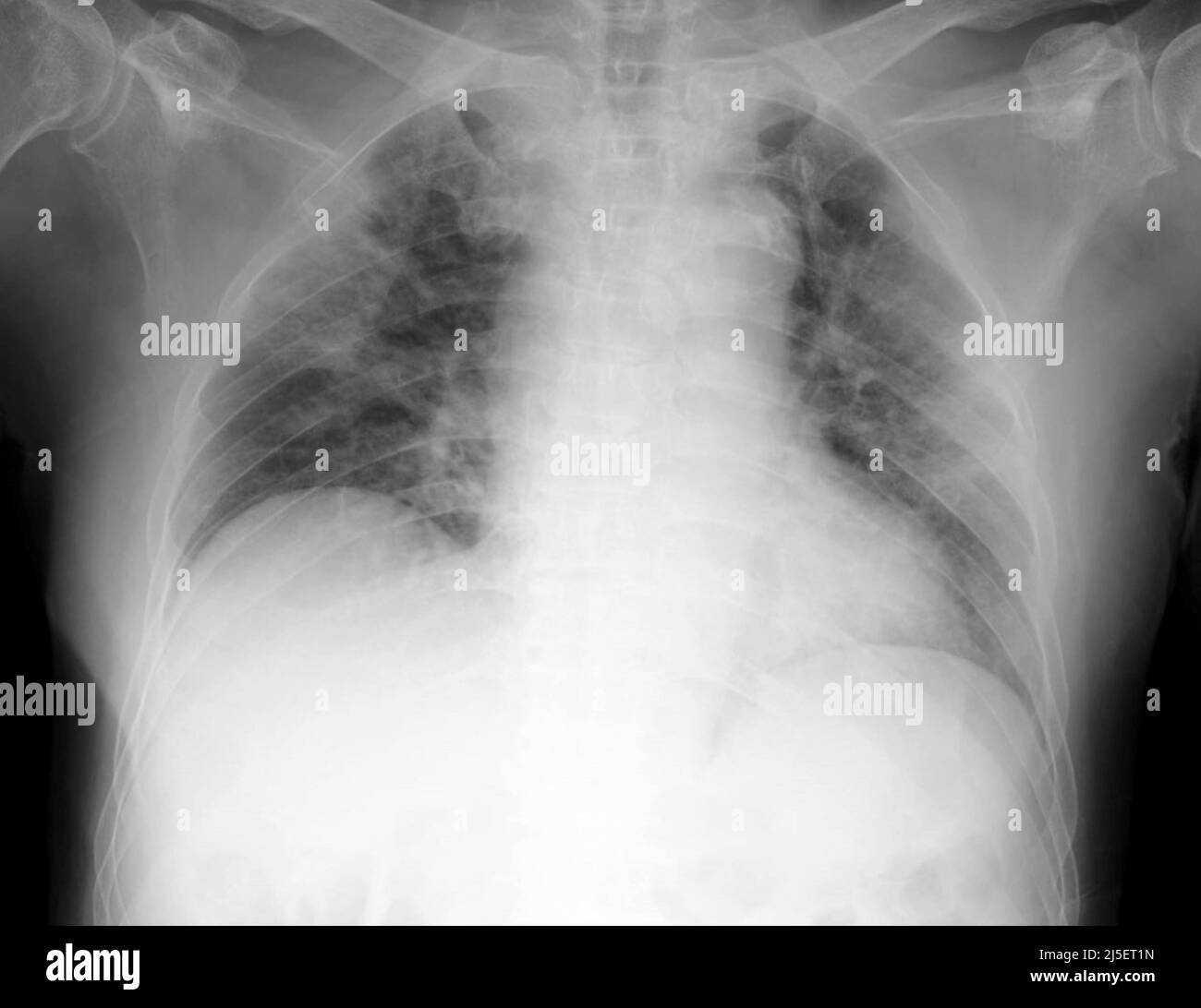 Pneumonie Covid-19, radiographie Banque D'Images