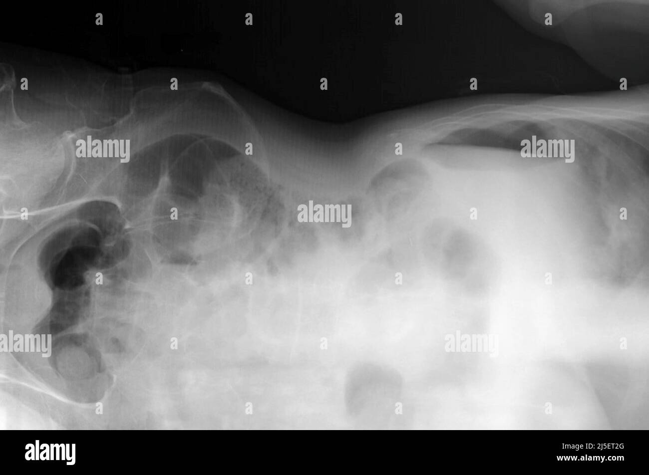 Cavidad peritoneal Banque de photographies et d’images à haute ...