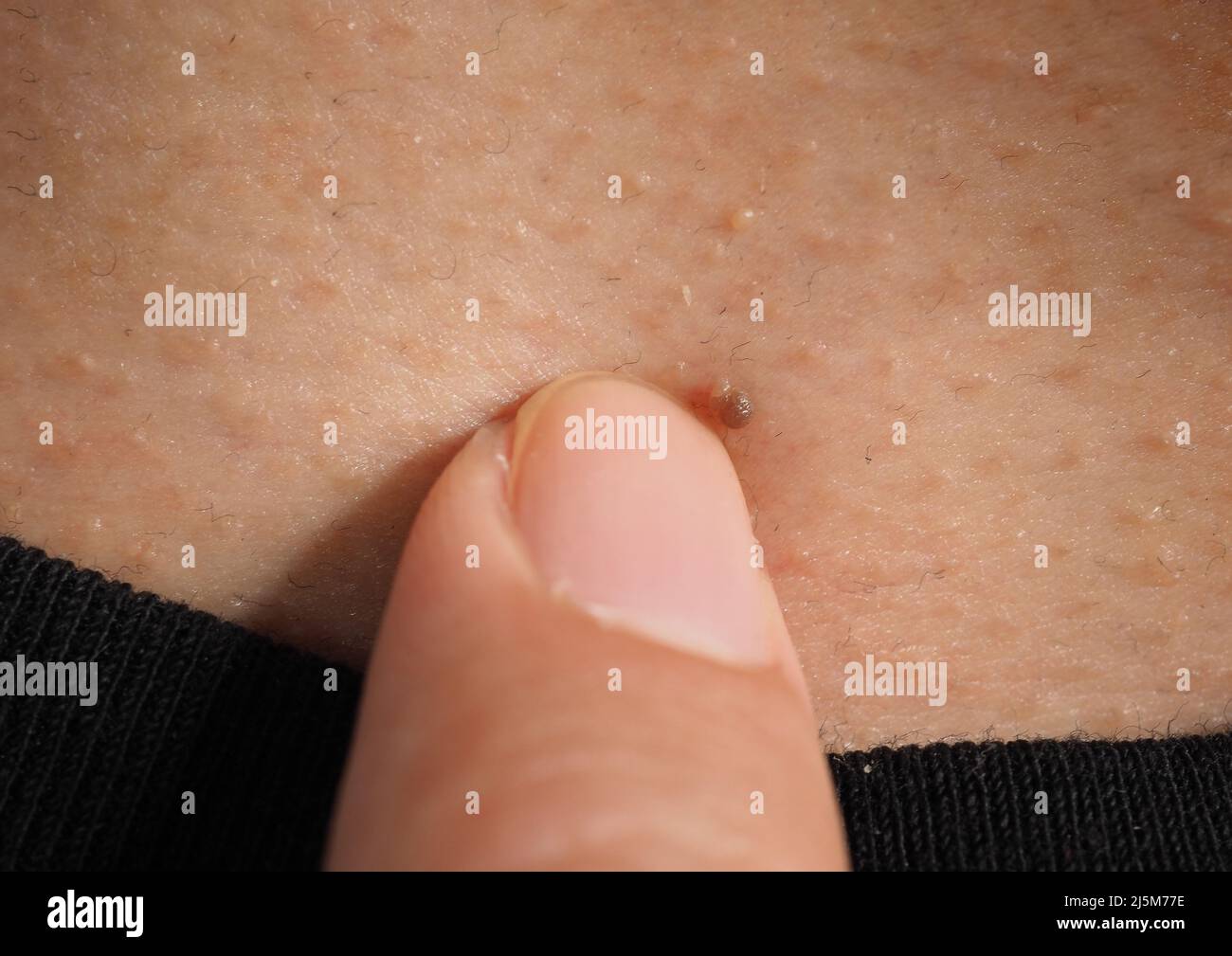 Élimination de la déformation cutanée. Photo macro des verrues près de l'œil sur le visage. Papillome sur la peau autour du nez et du cou des yeux. Marque de naissance papilla ou mole sur la peau. Petit dur. Être Banque D'Images