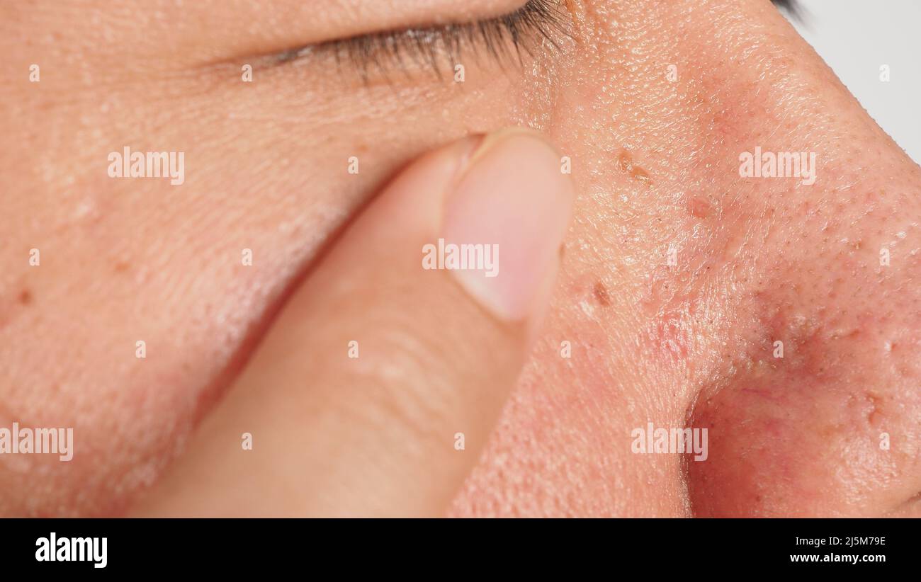 Élimination de la déformation cutanée. Photo macro des verrues près de l'œil sur le visage. Papillome sur la peau autour du nez et du cou des yeux. Marque de naissance papilla ou mole sur la peau. Petit dur. Être Banque D'Images