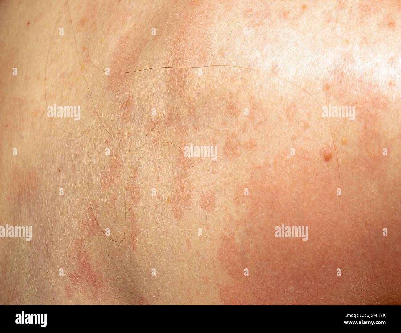 Psoriasis état de santé taches rouges sur le dos de la peau Photo ...