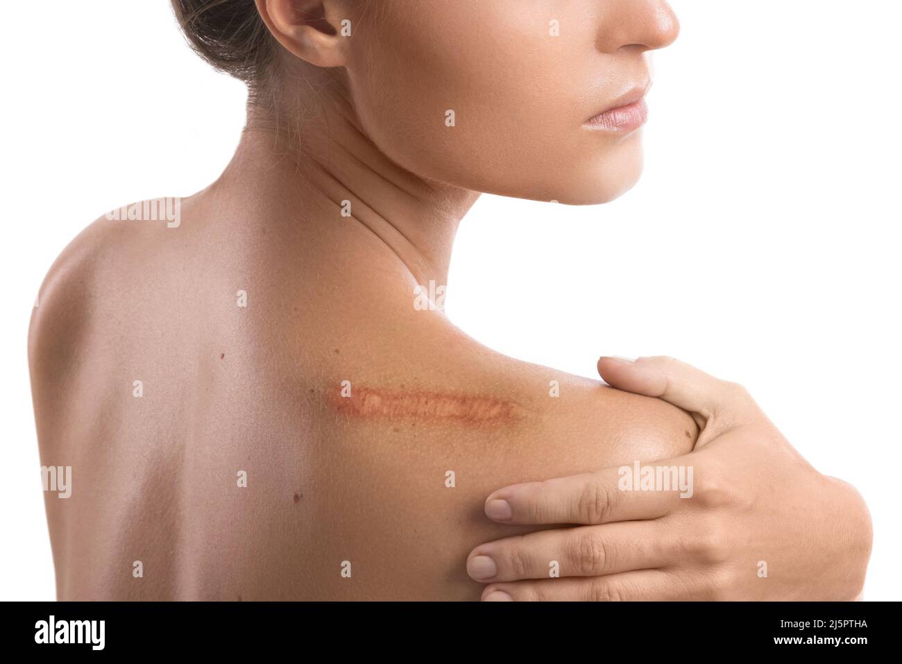 Femme avec une cicatrice sur son épaule Banque D'Images