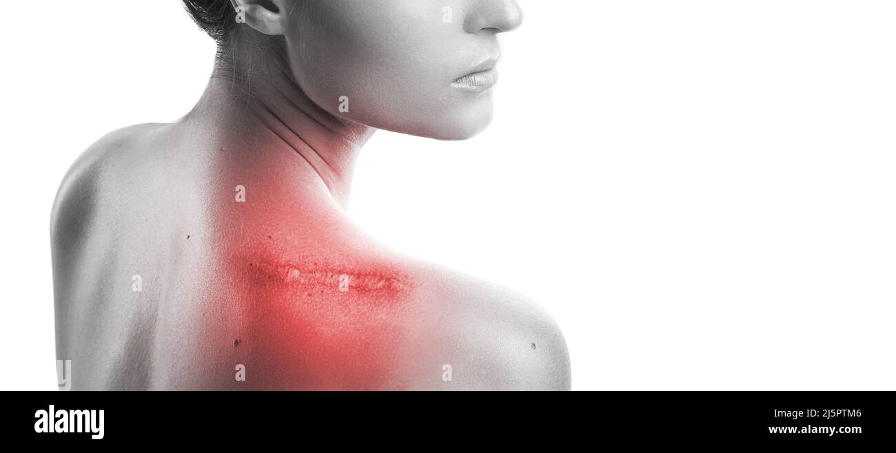 Femme avec une cicatrice sur son épaule Banque D'Images