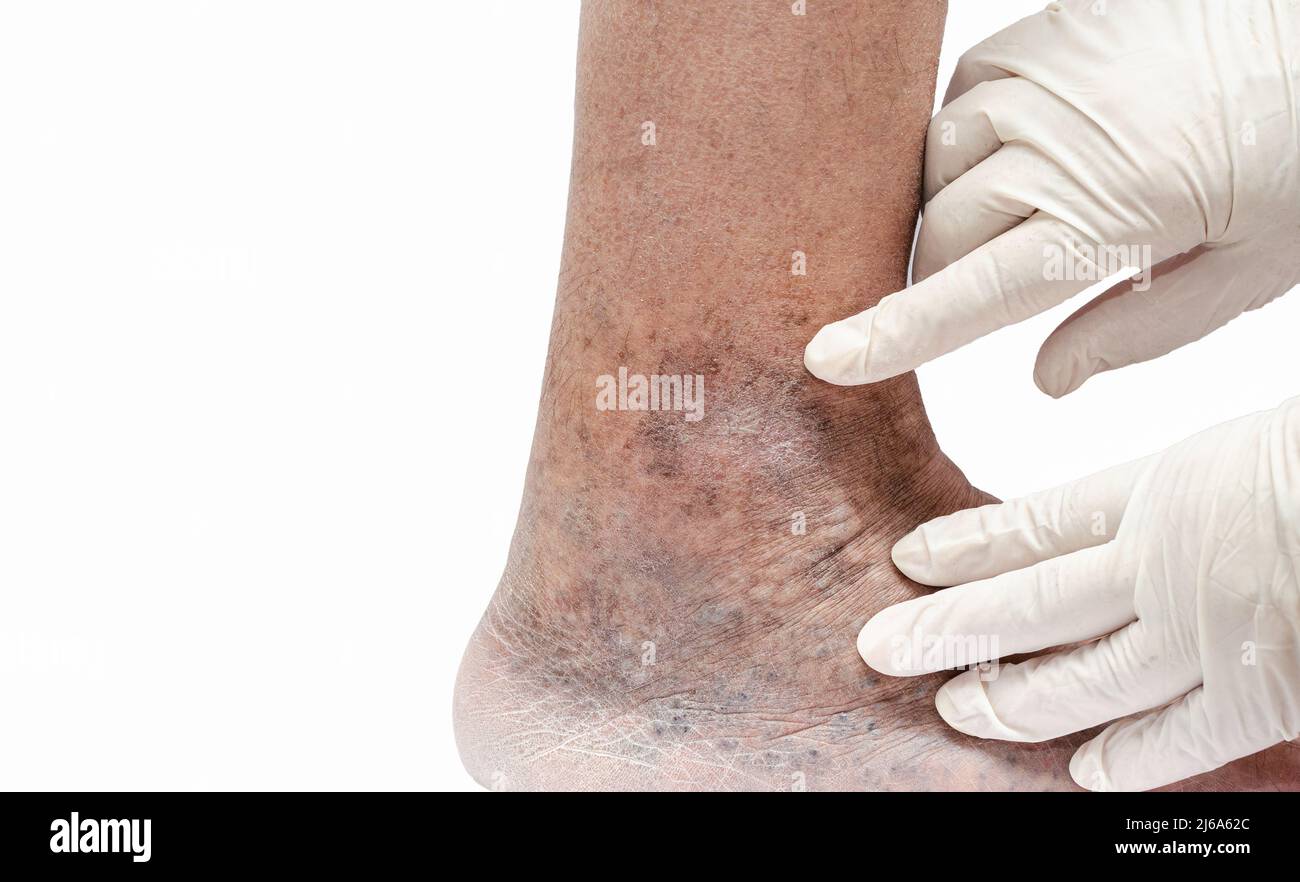 Médecin en gants blancs tenant le pied de l'homme et pointant vers les varices, la thrombose veineuse profonde, les blessures veineuses sur le pied. Ulcère variqueux sain. Isola Banque D'Images