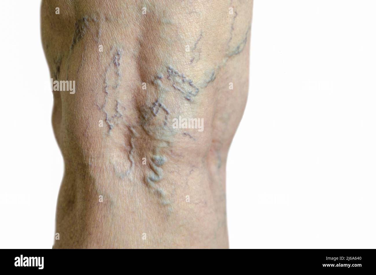 Jambe d'une femme plus âgée avec varices, thrombose veineuse profonde. Isolé sur fond blanc. Télangiectasias. Banque D'Images