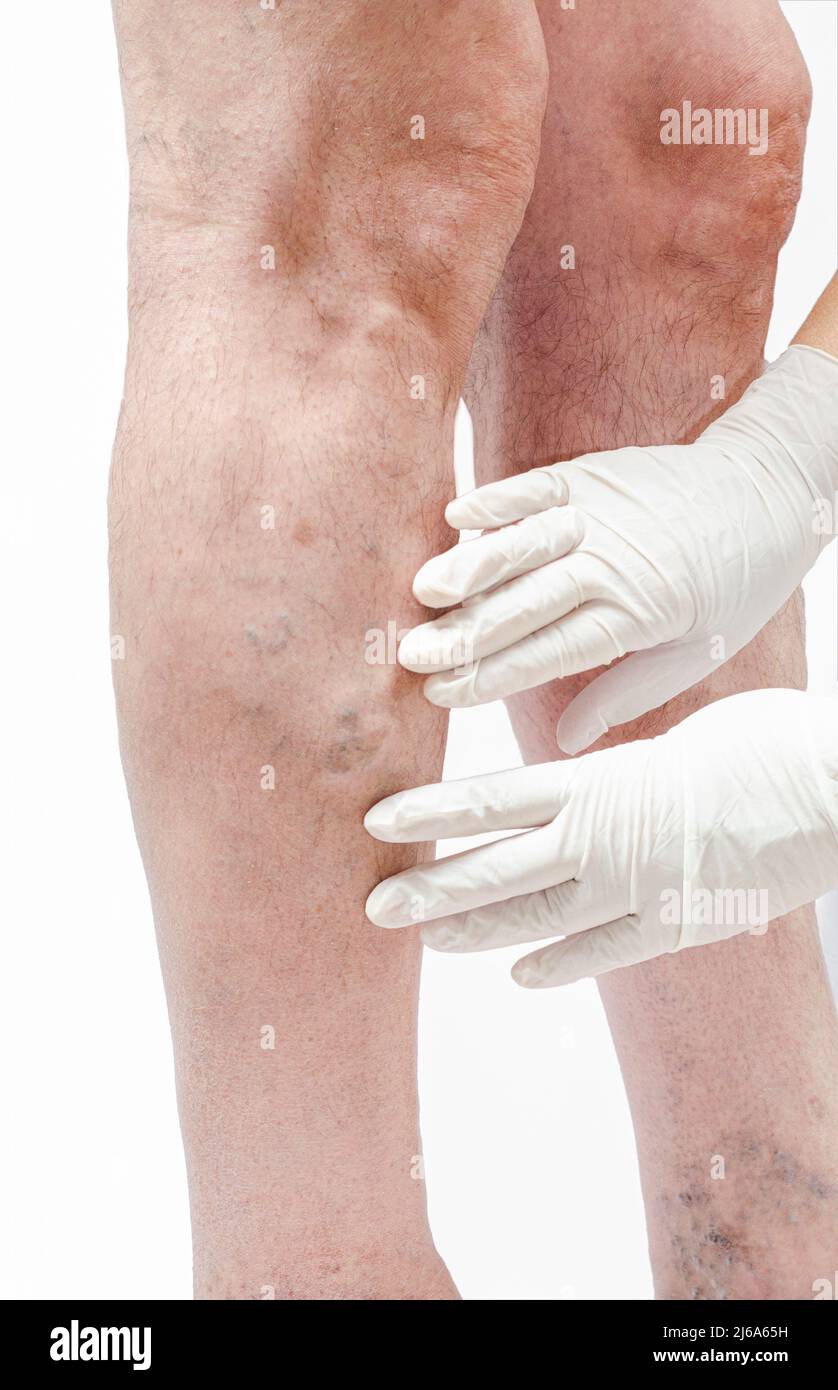 Médecin en gants blancs tenant le pied de l'homme et pointant vers les varices, la thrombose veineuse profonde, les blessures veineuses sur le pied. Ulcère variqueux sain. Isola Banque D'Images