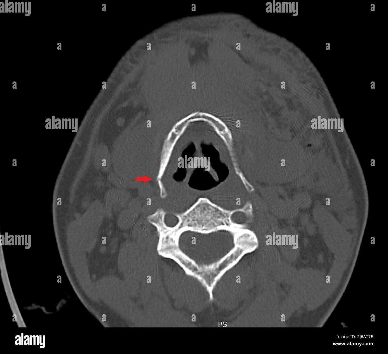 Os hyoïde fracturé, acquisition CT Banque D'Images
