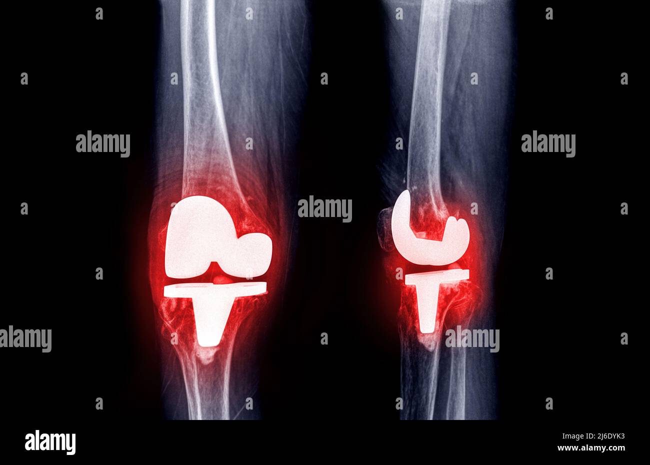 Filmez les rayons X du genou AP et la vue latérale du patient atteint d'arthrose du genou et de l'articulation artificielle avec remplacement du genou. Banque D'Images Filmez les rayons X du genou AP et la vue latérale du patient atteint d'arthrose du genou et de l'articulation artificielle avec remplacement du genou. Banque D'Images