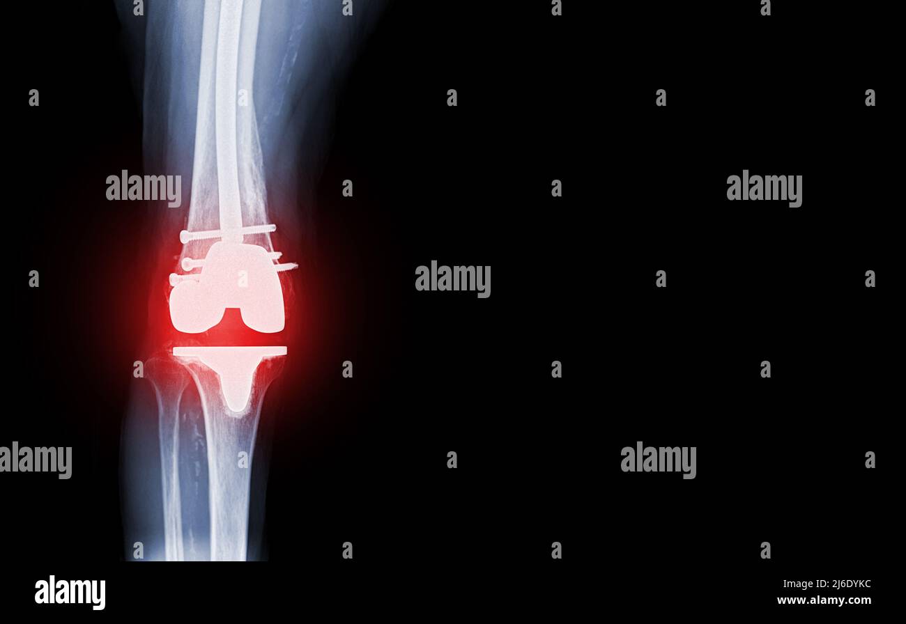 Filmer la vue AP du genou à rayons X du patient souffrant d'arthrose du genou et de l'articulation artificielle avec remplacement du genou. Banque D'Images Filmer la vue AP du genou à rayons X du patient souffrant d'arthrose du genou et de l'articulation artificielle avec remplacement du genou. Banque D'Images