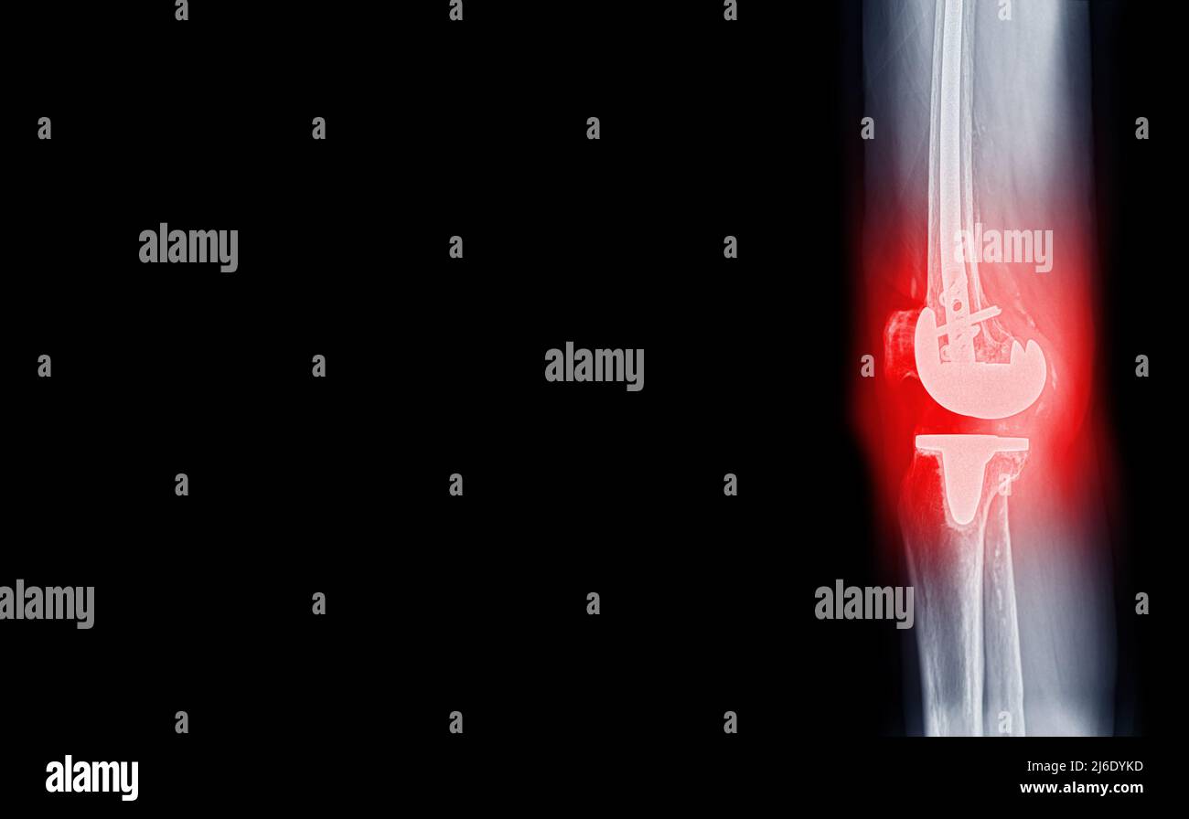 Filmez la vue latérale par rayons X du patient atteint d'arthrose du genou et de l'articulation artificielle avec remplacement du genou. Banque D'Images Filmez la vue latérale par rayons X du patient atteint d'arthrose du genou et de l'articulation artificielle avec remplacement du genou. Banque D'Images