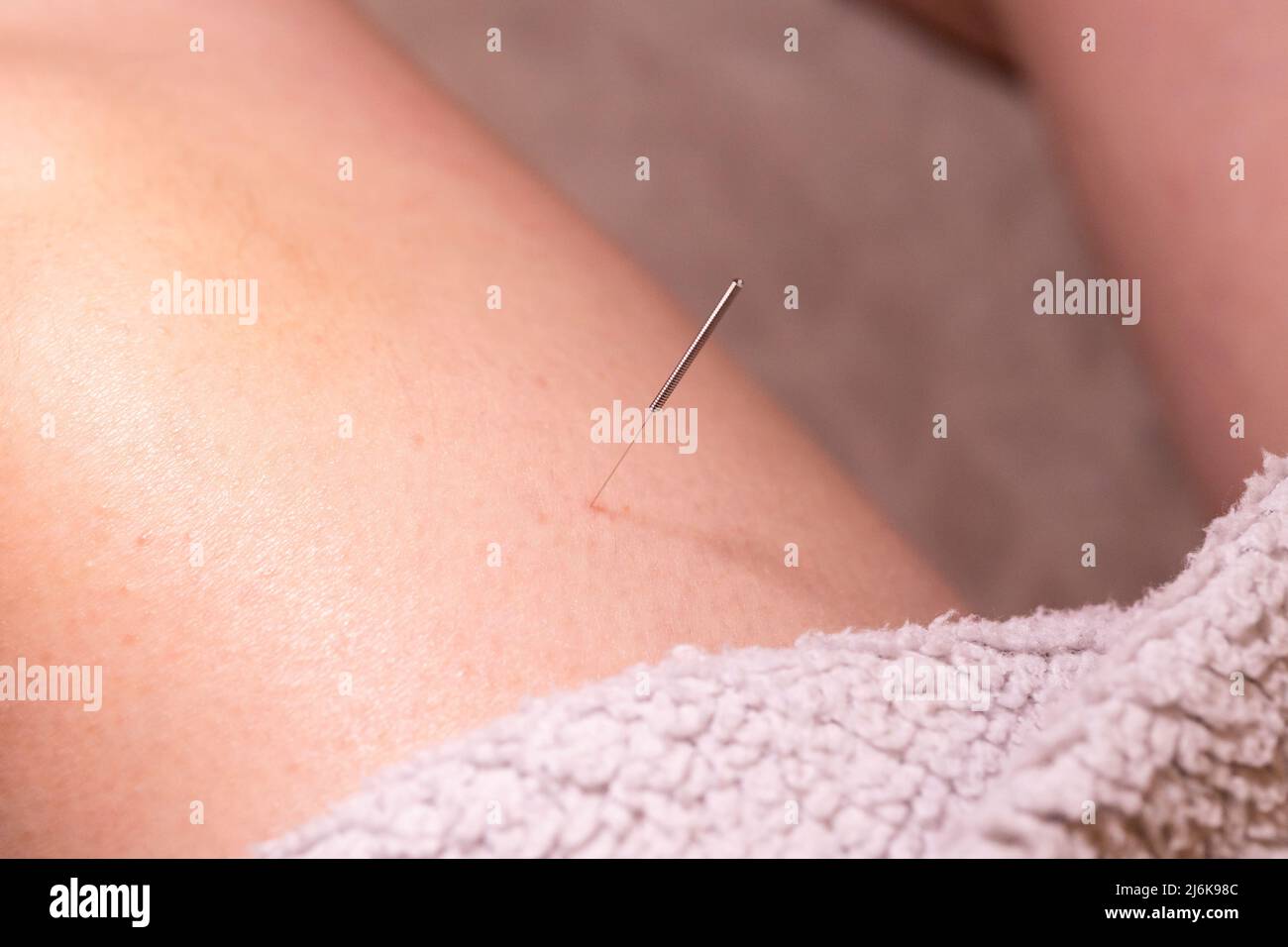 Un portrait d'une fine aiguille d'acupuncture placée sur la partie supérieure de la jambe, mis en place par un acupuncteur. Ce traitement de médecine alternative est utilisé pour l'héa Banque D'Images