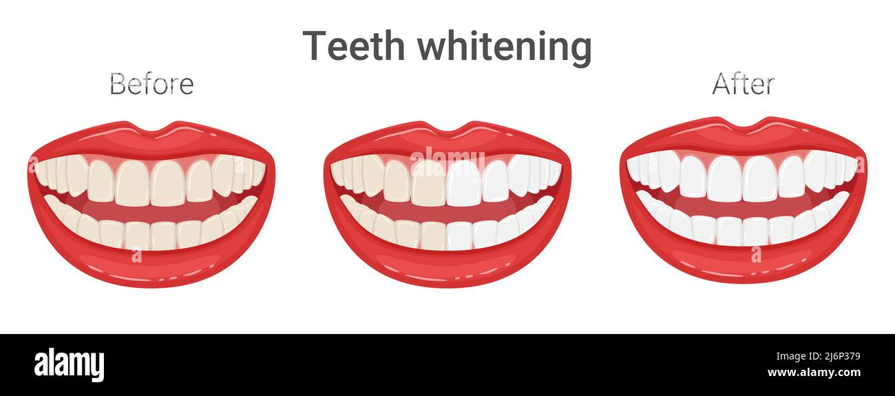 Même les dents jaunes et blanches dans la bouche. Blanchiment des dents. Bouche dans un sourire. Dentisterie esthétique. Comparaison avant et après. Style de vie sain, bosselure Illustration de Vecteur