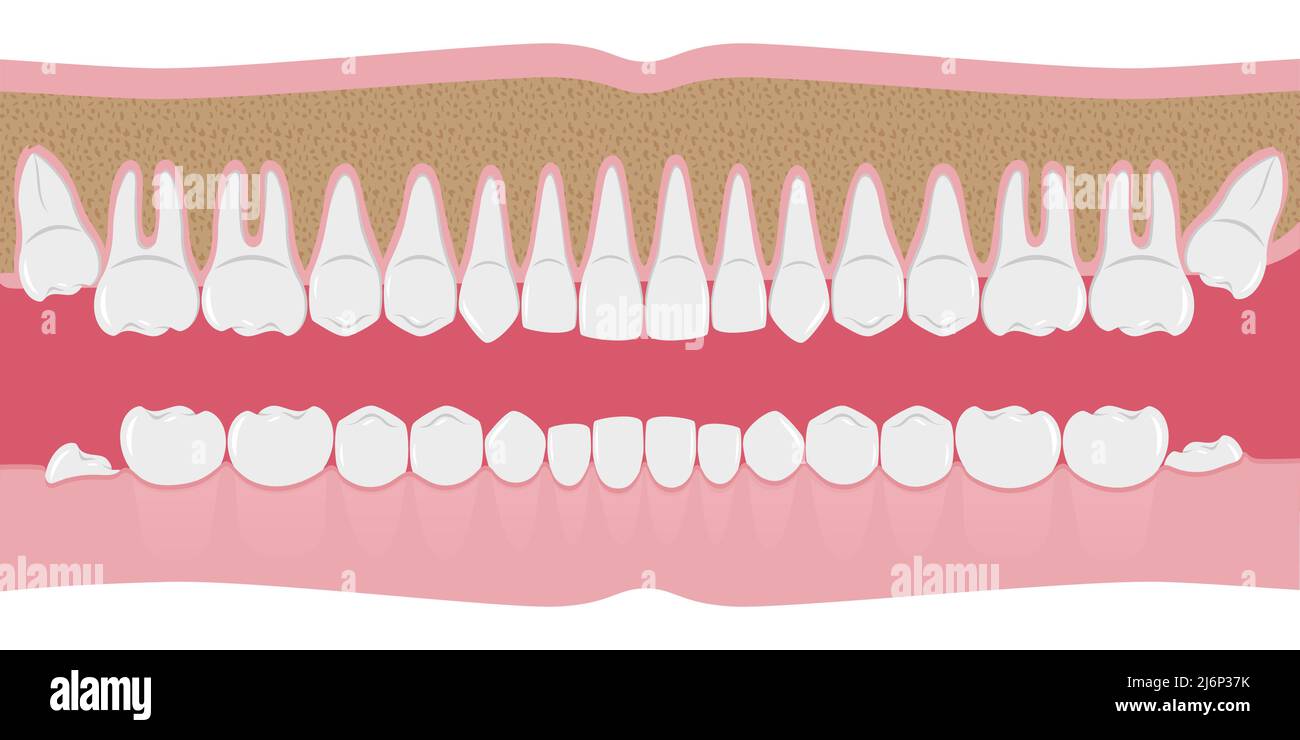 Dents humaines blanches en bonne santé d'affilée. Des dents belles et même aux racines. Les gencives sont coupées à l'os. Structure des éléments Jaw.Infographic pour la bosselure Illustration de Vecteur